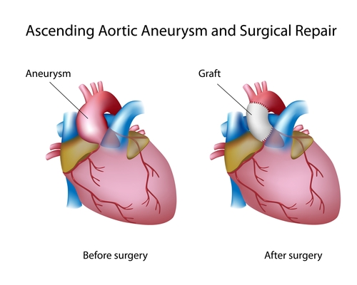 Psoriasis and aortic aneurysms