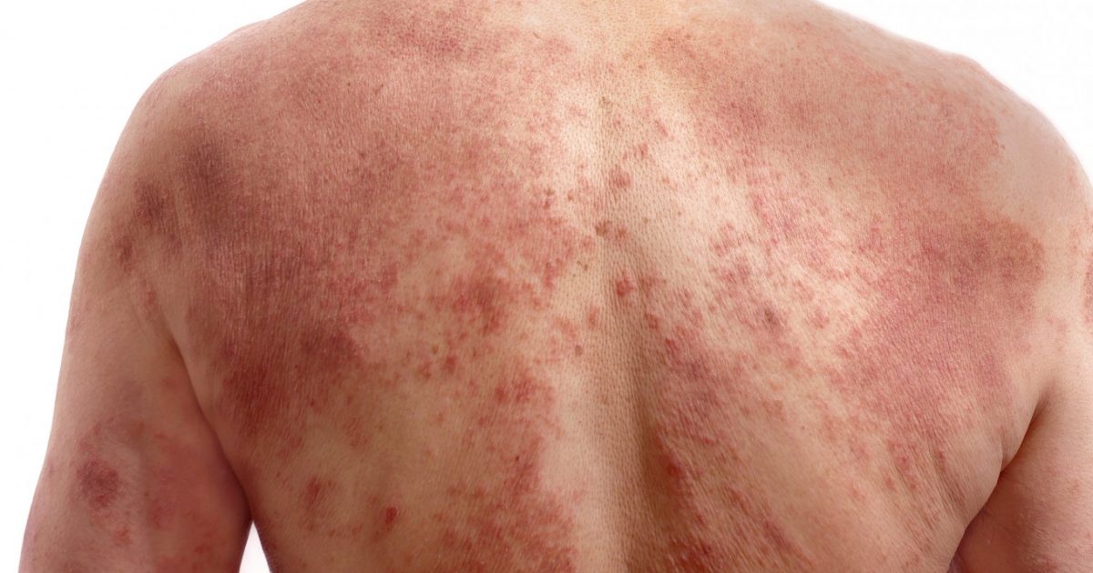 rash from neurontin