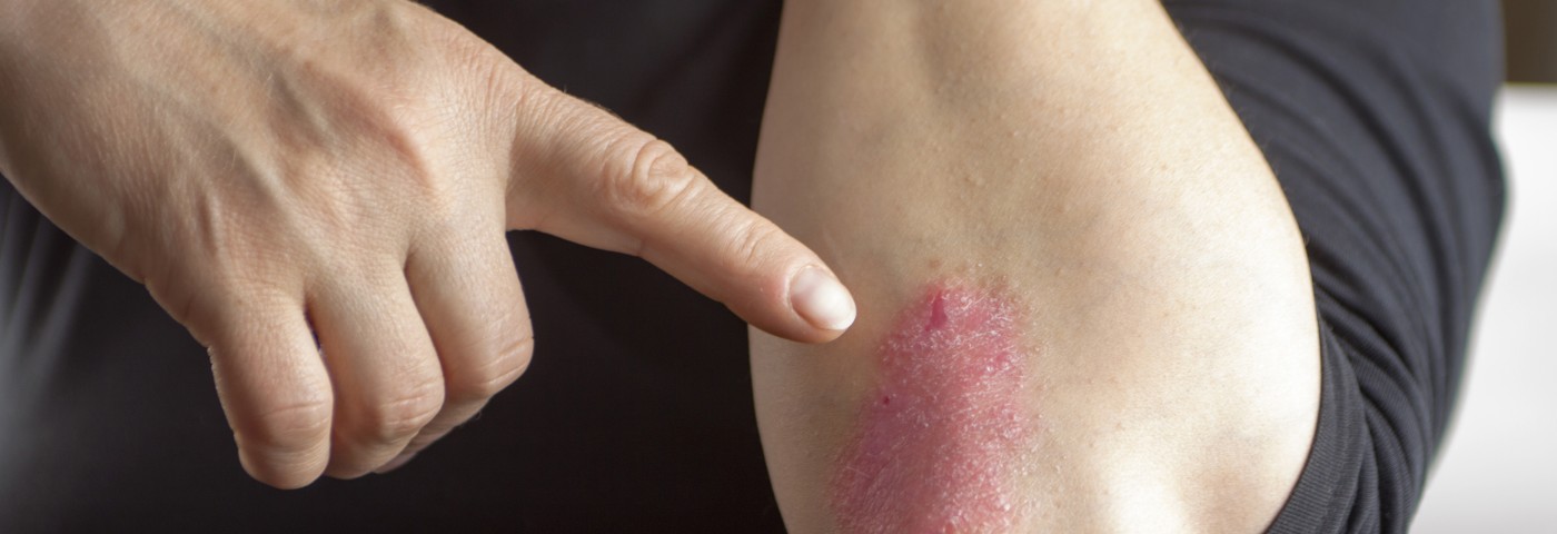 Laser Therapy for Psoriasis Shows No Indication of Koebner Effect, According to Study