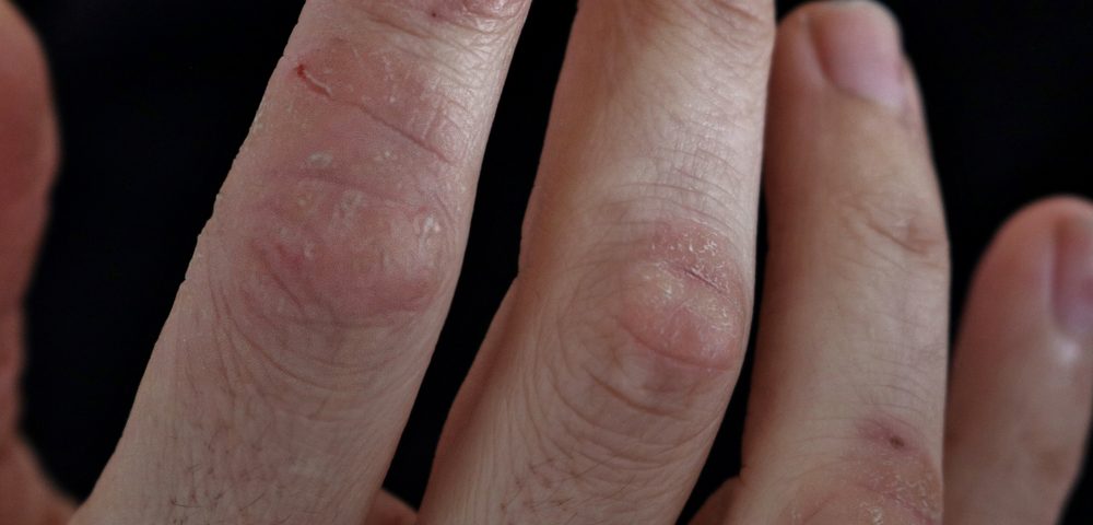 Skin’s Immune Response Thrown Off Balance in Psoriasis, Study Finds