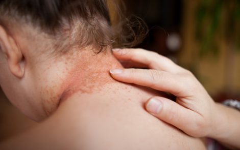 XTRAC Light Therapy Effectively Treats Psoriasis Lesions Without the Serious Side Effects of Rival Therapies, Says Strata