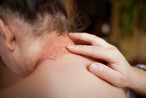 XTRAC Light Therapy Effectively Treats Psoriasis Lesions Without the Serious Side Effects of Rival Therapies, Says Strata