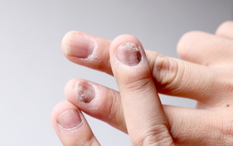 Pfizer’s Xeljanz Reduced Nail Psoriasis in Phase 3 Trials of Plaque Disease